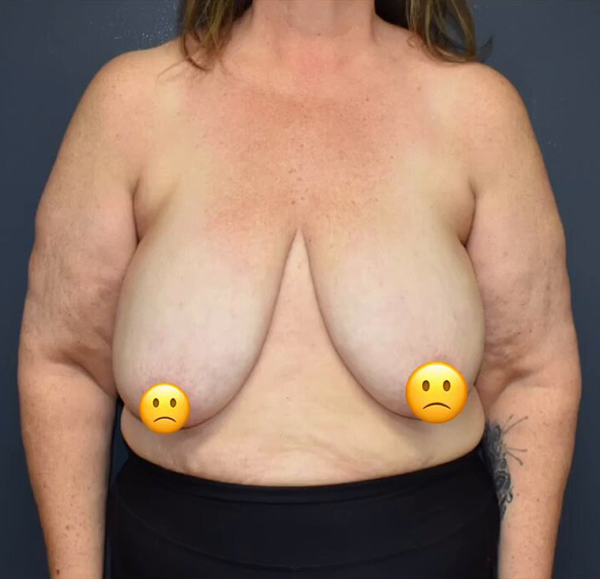 Breast Reduction