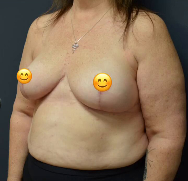 Breast Reduction