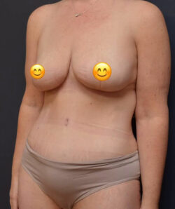 Mommy Makeover