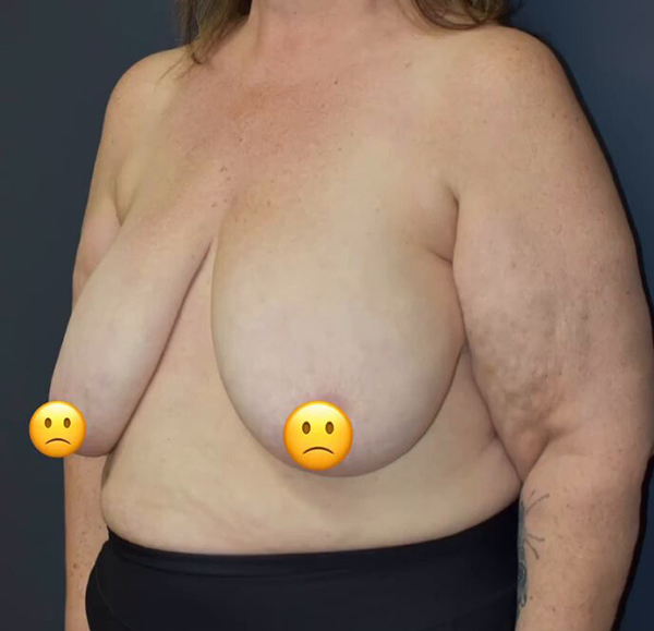 Breast Reduction