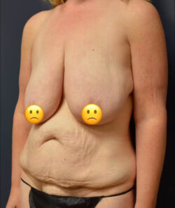 Mommy Makeover