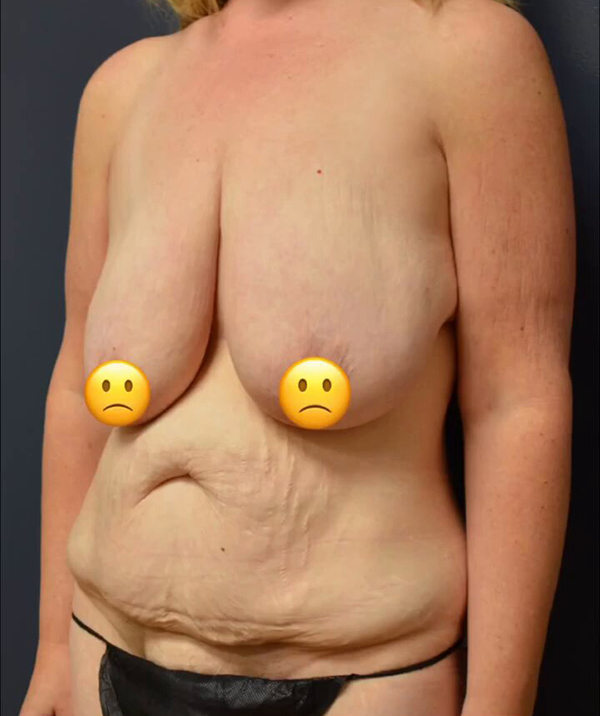 Mommy Makeover