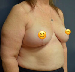 Breast Reduction