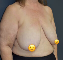 Breast Reduction
