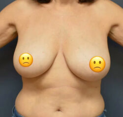Breast Reduction