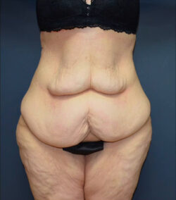 Lower Body Lift