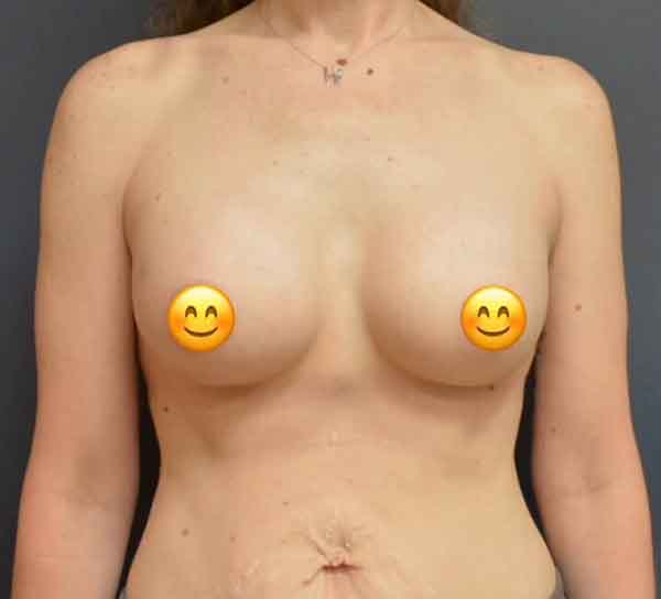 Breast Augmentation