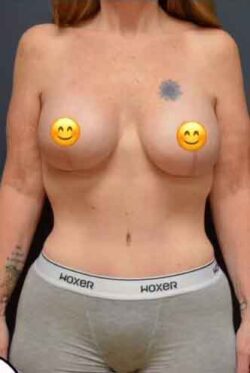 Abdominoplasty