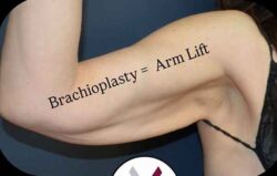 Arm Lift
