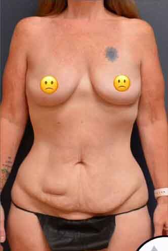 Abdominoplasty Case 27672 Before Photo Abdominoplasty