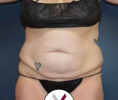 Abdominoplasty Case 27675 Before Photo Abdominoplasty
