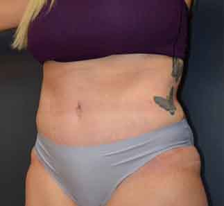Abdominoplasty