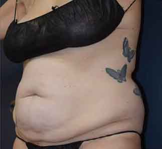 Abdominoplasty