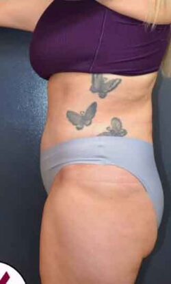 Abdominoplasty