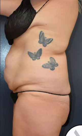 Abdominoplasty