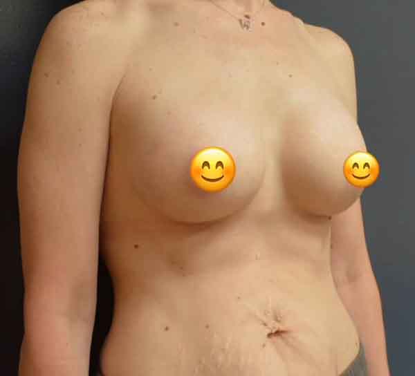 Breast Augmentation