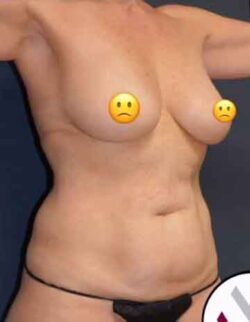 Abdominoplasty