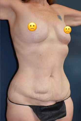 Abdominoplasty