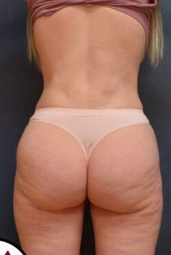 Abdominoplasty