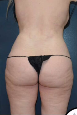 Abdominoplasty