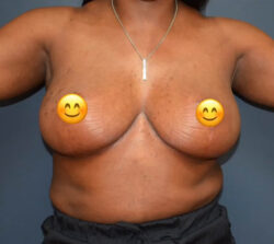 Breast Implant Removal