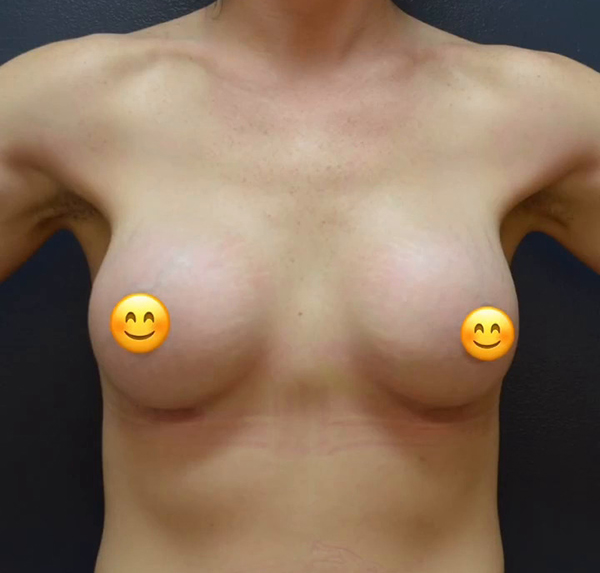 Breast Augmentation