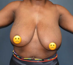 Breast Implant Removal