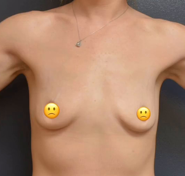 Breast Augmentation