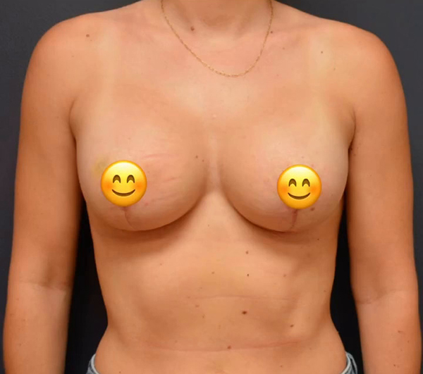 Breast Lift with Augmentation