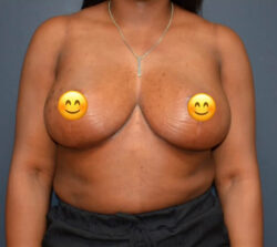Breast Implant Removal