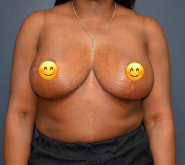 Breast Implant Removal