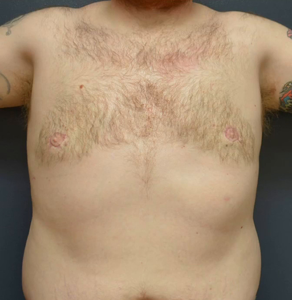 Gynecomastia - Male Breast Reduction