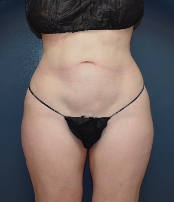 Abdominoplasty