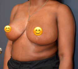 Breast Implant Removal
