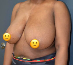 Breast Implant Removal