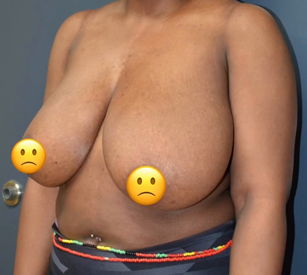 Breast Implant Removal