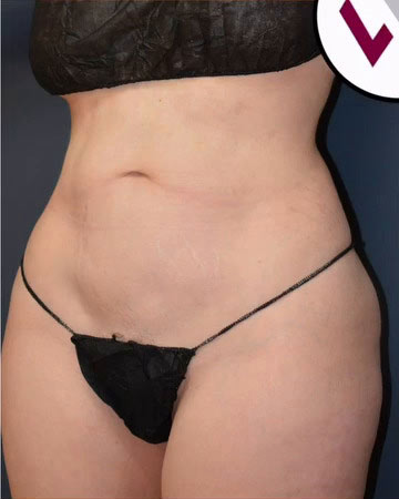 Abdominoplasty