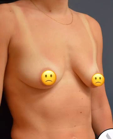 Breast Lift with Augmentation