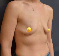 Breast Augmentation