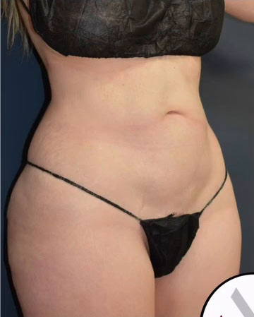 Abdominoplasty