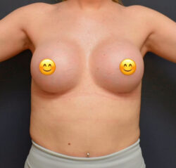 Breast Augmentation