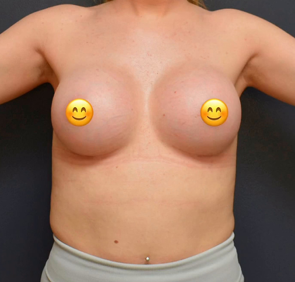 Breast Augmentation
