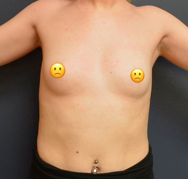 Breast Augmentation