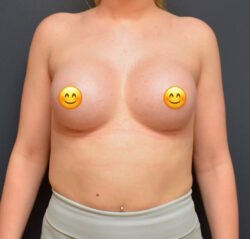 Breast Augmentation