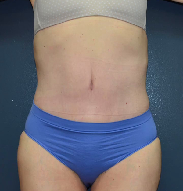 Abdominoplasty