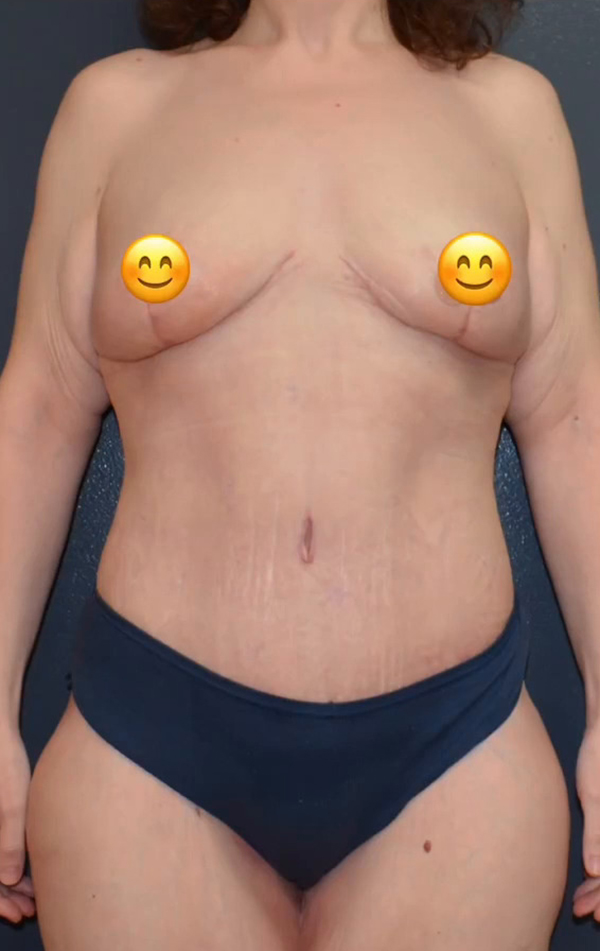 Abdominoplasty