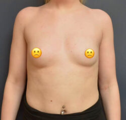 Breast Augmentation