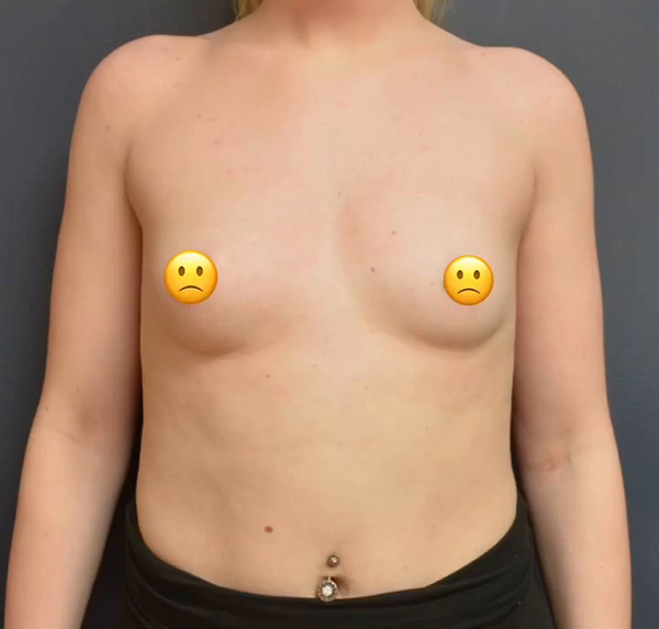 Breast Augmentation Case 29156 Before Photo Breast Augmentation
