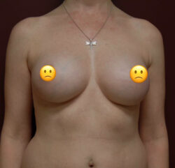 Breast Implant Removal