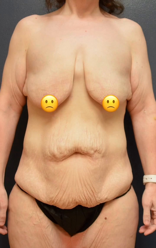 Abdominoplasty